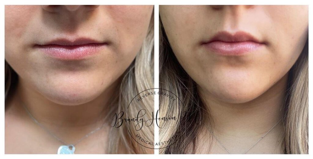 Before and After Botox Lip Pop