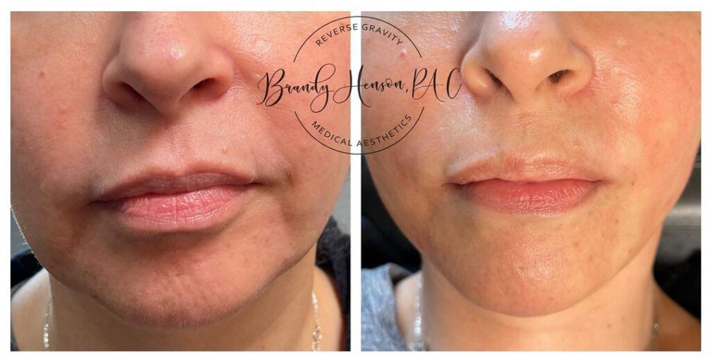 Before and After Cheek and Jowl Lift with PDO Threads