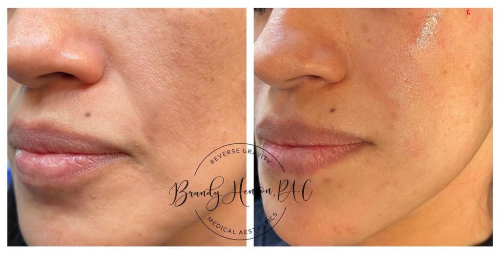 Before and After Cheek and NLF Fold Lift with PDO Threads