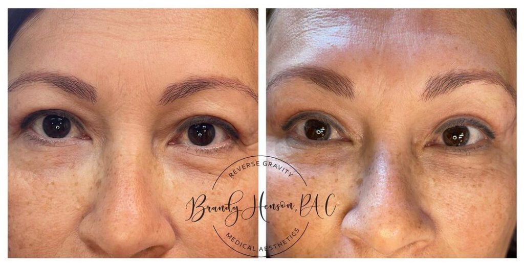 Before and After Eyebrow Lift with PDO Threads