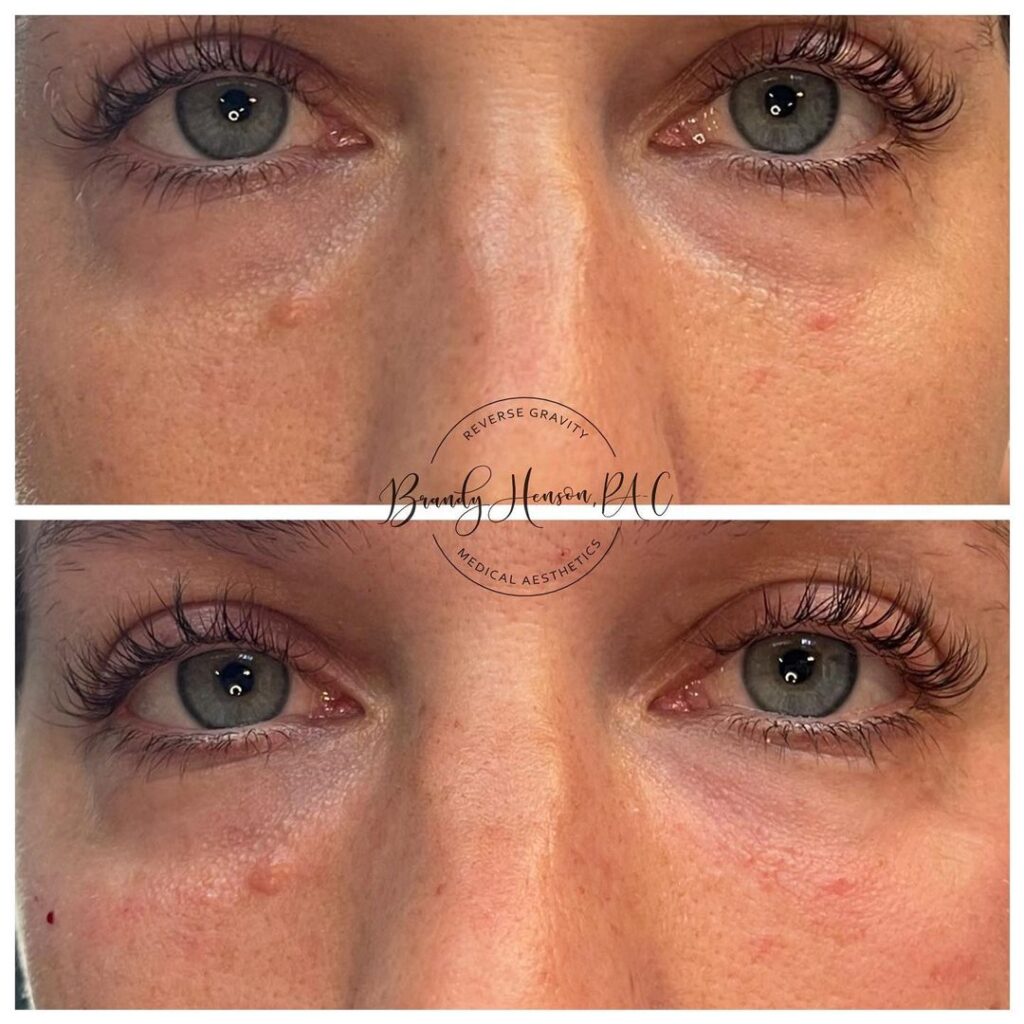 Before and After Fillers with PRF