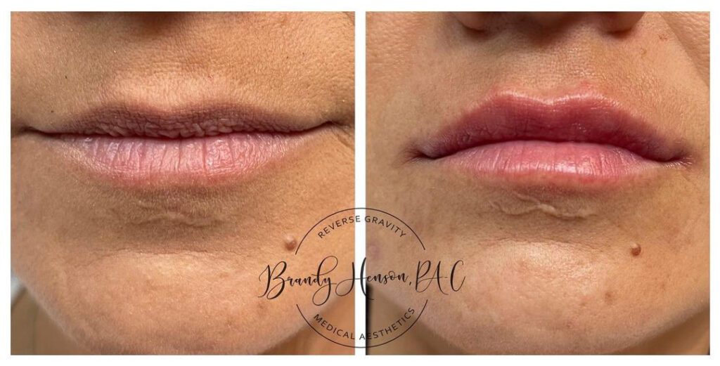 First-time Lip Filler - Before and After