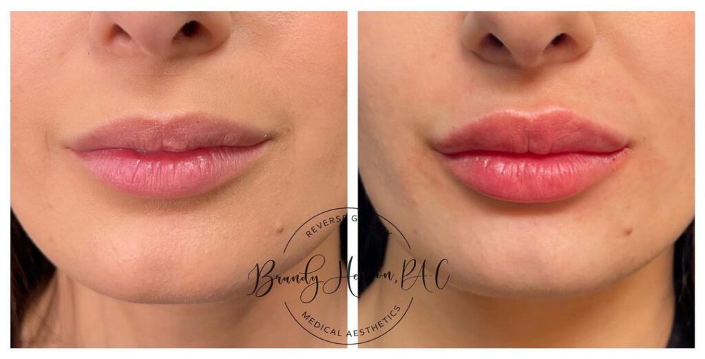 Before and After Lip Fillers