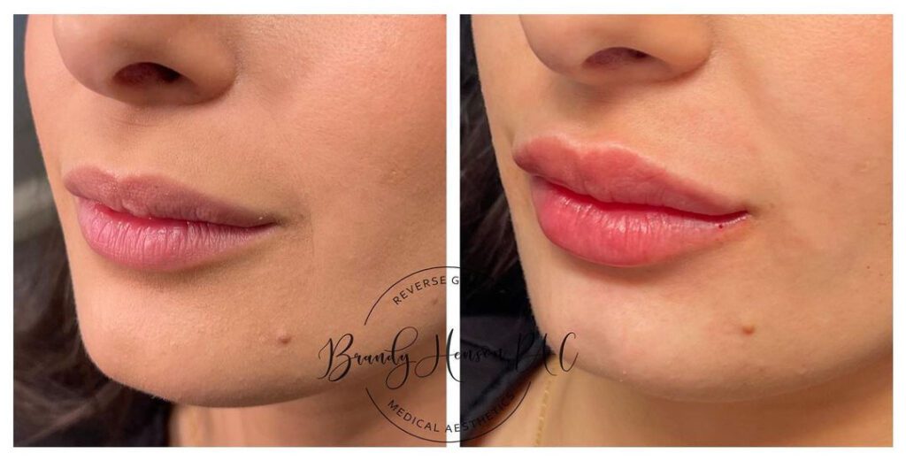 Before and After Lip Fillers