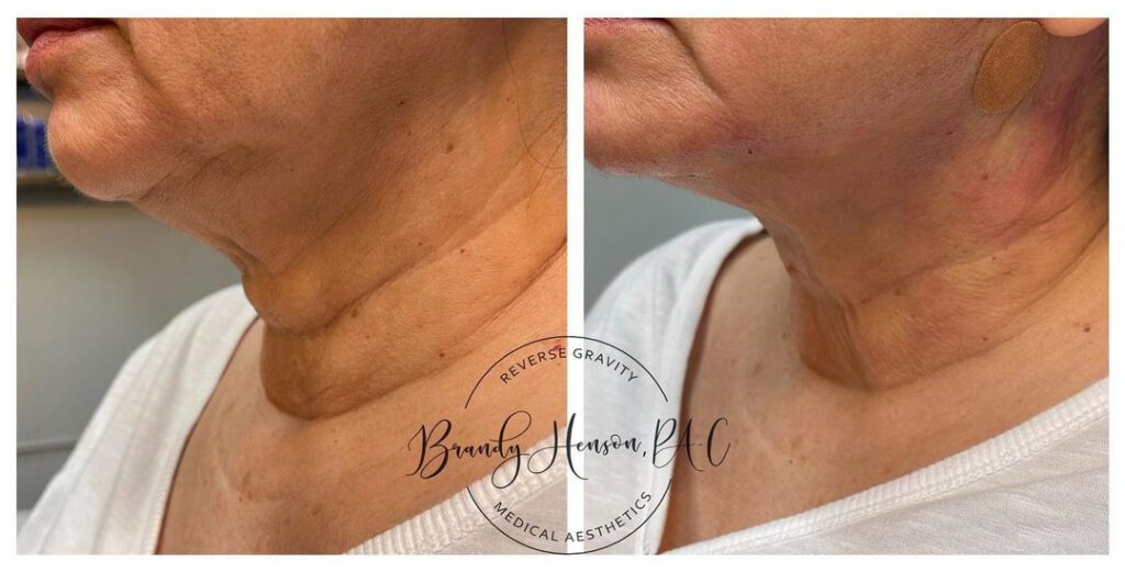 Before and After Neck Lift with PDO Threads
