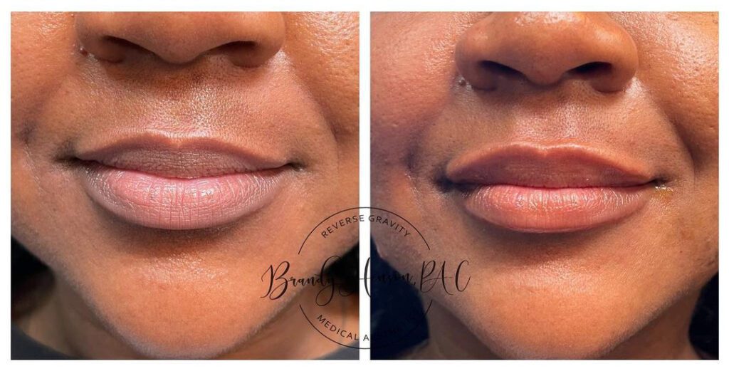 Before and After Lip Asymmetry Fix