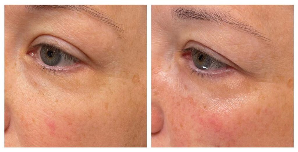Before and After Tear Trough Correction