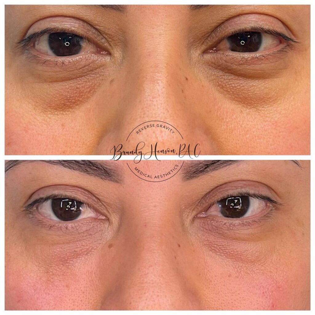 Undereye Correction Before and After