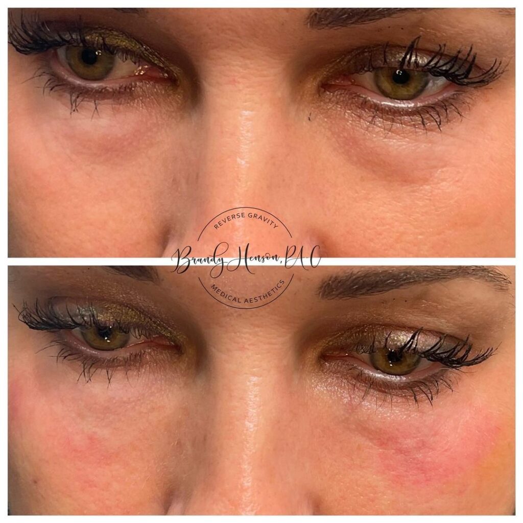 Before and After Under Eye Correction