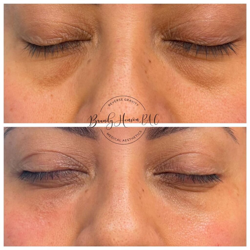 Under Eye Correction Before and After