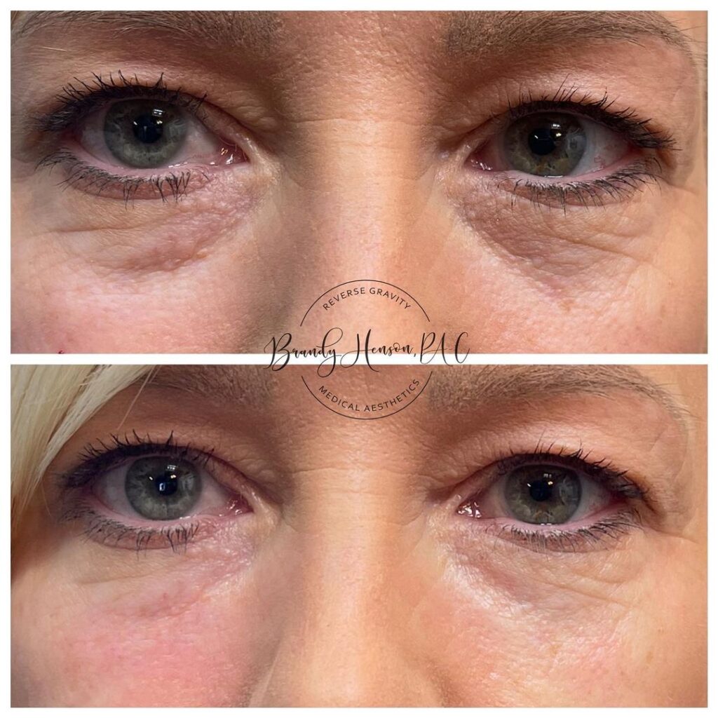 Before and After Undereye Fillers