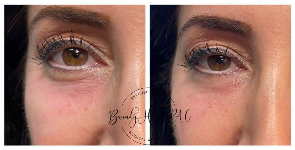 Before and After Undereye Filler