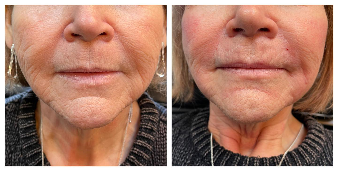 Before and After Botox, Filler, and PDO Threads