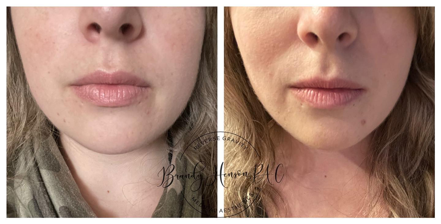 Before and After Botox in the Masseter Muscle