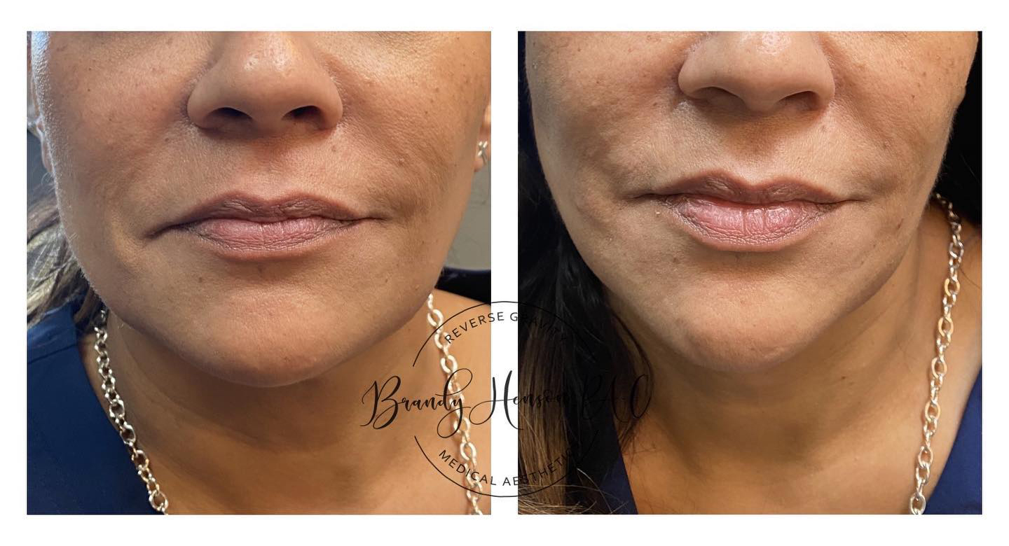 Before and After Cheek and Jowl Lift