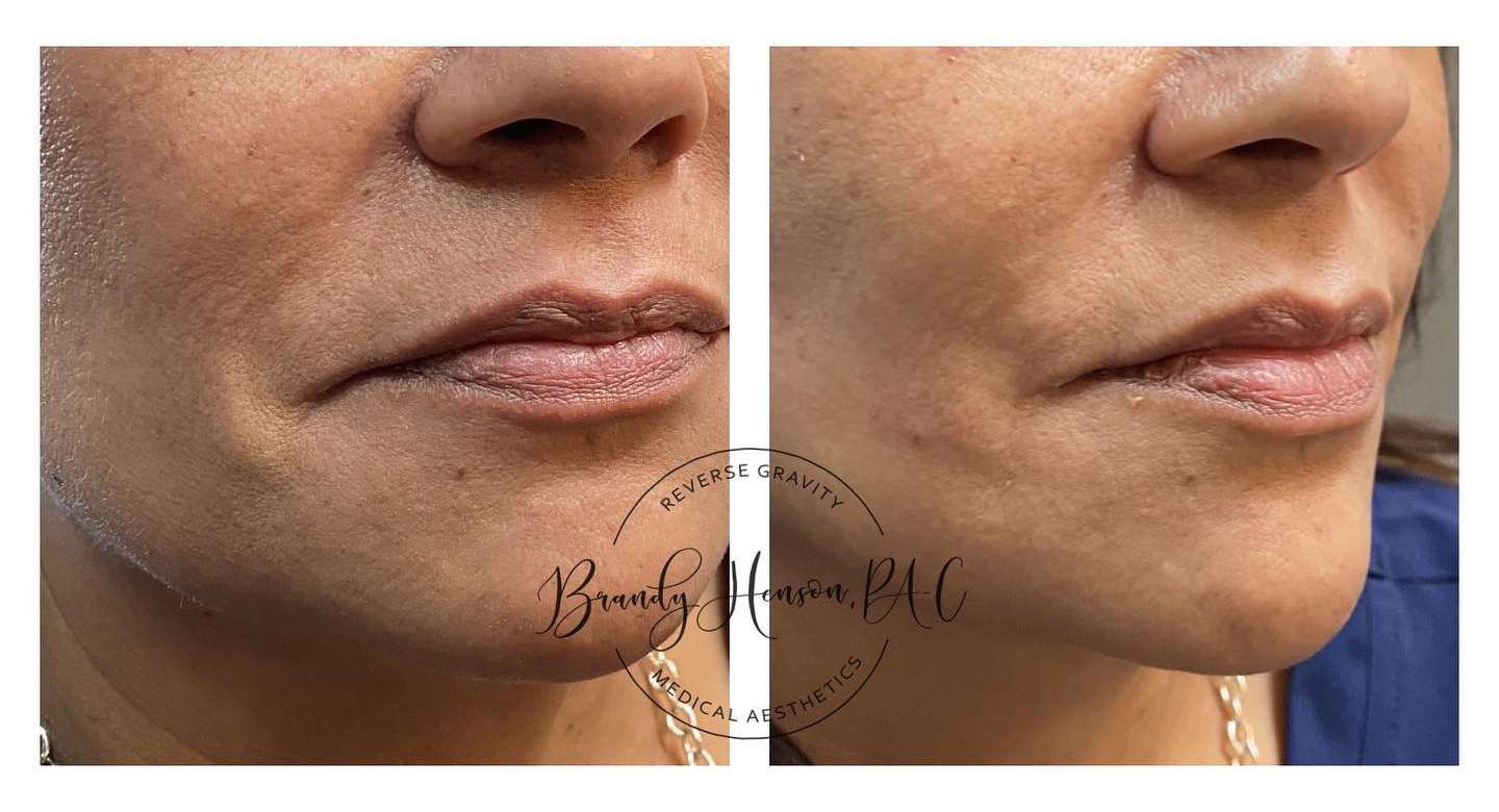 Before and After Cheek and Jowl Lift