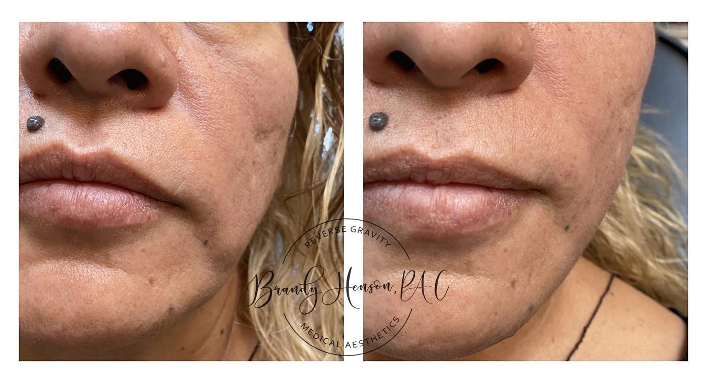 Before and After Cheek and Jowl Lift with PDO Threads