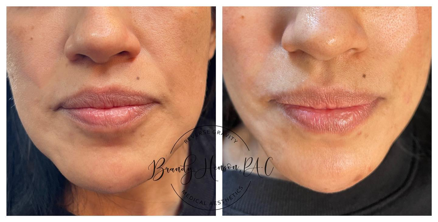Before and After Cheek and Nasolabial PDO Thread Lift