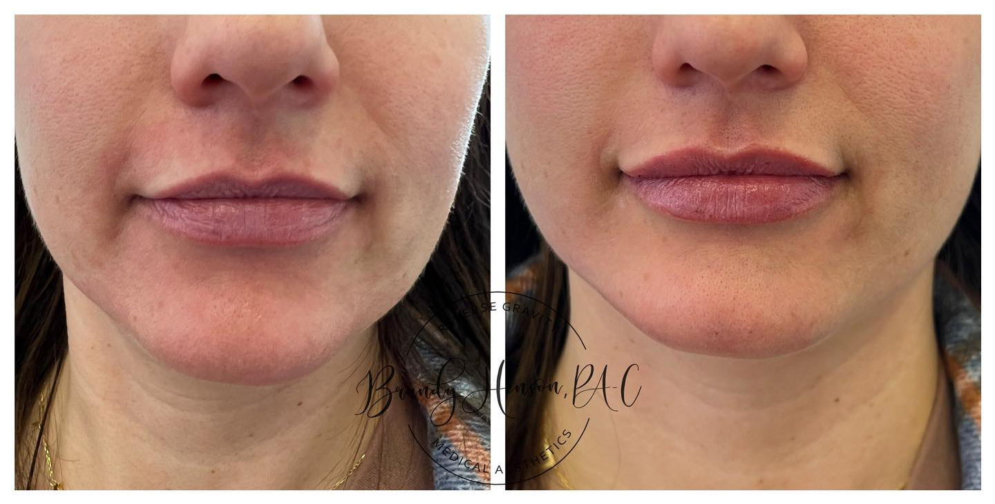 Chin asymmetry correction before and after