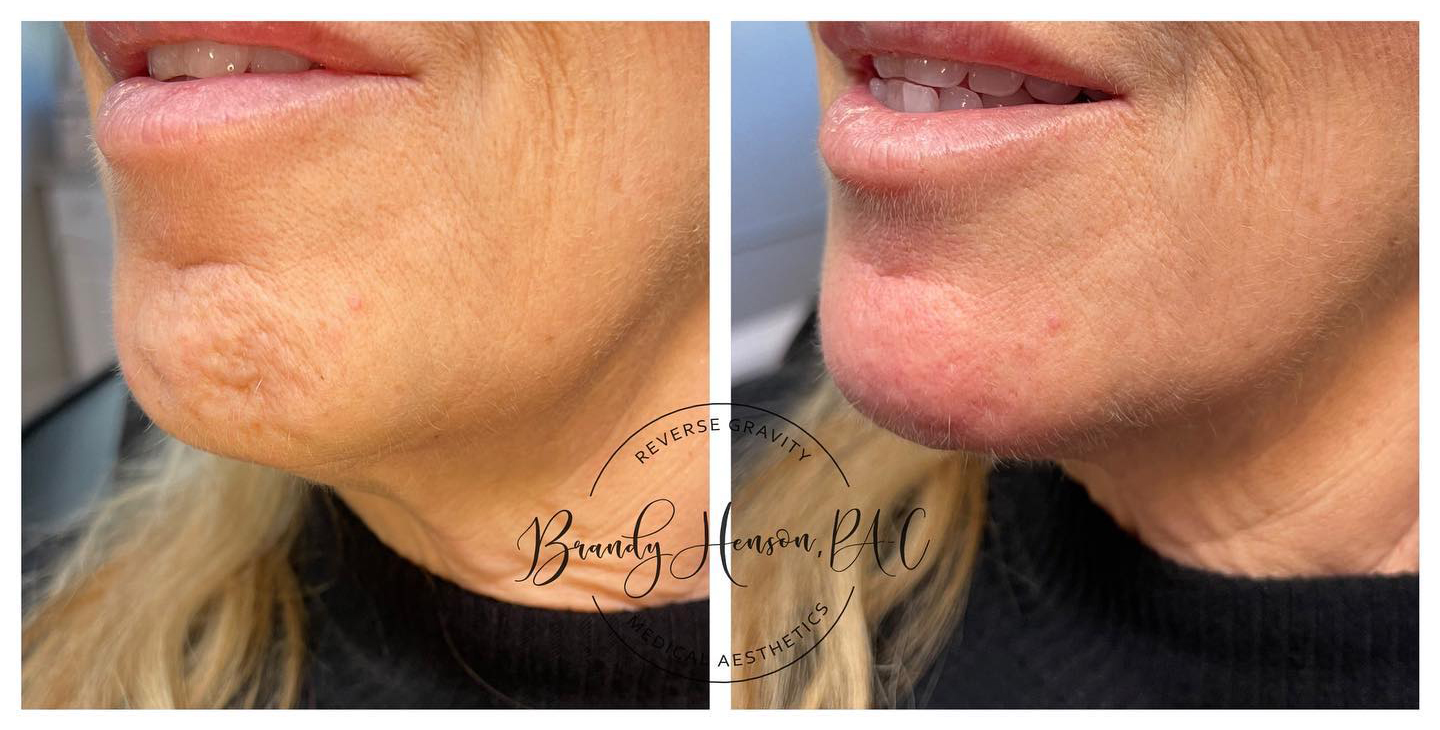 Before and After Chin Filler