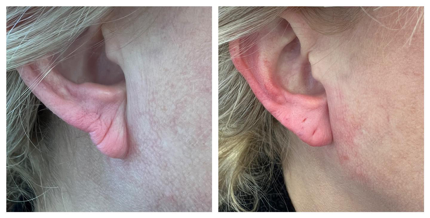 Earlobe rejuvenation before and after