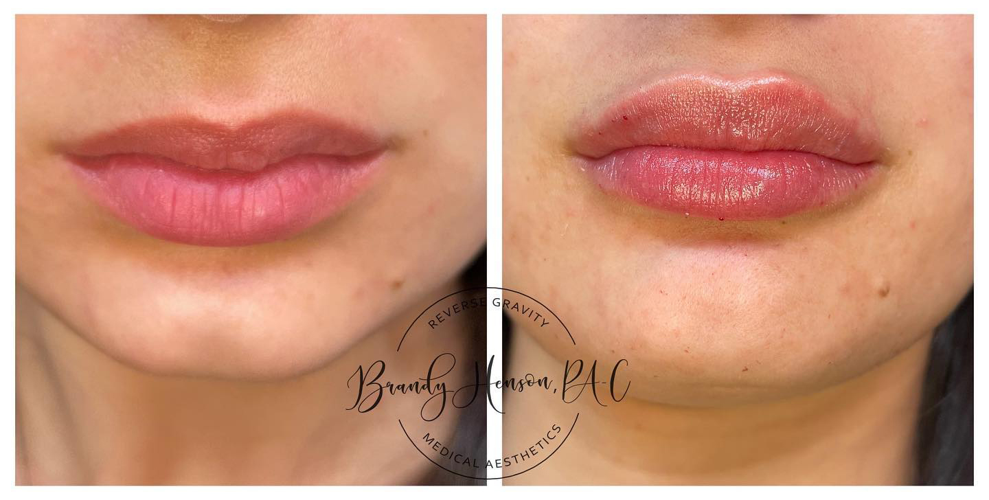 Before and After First Time Lip Filler