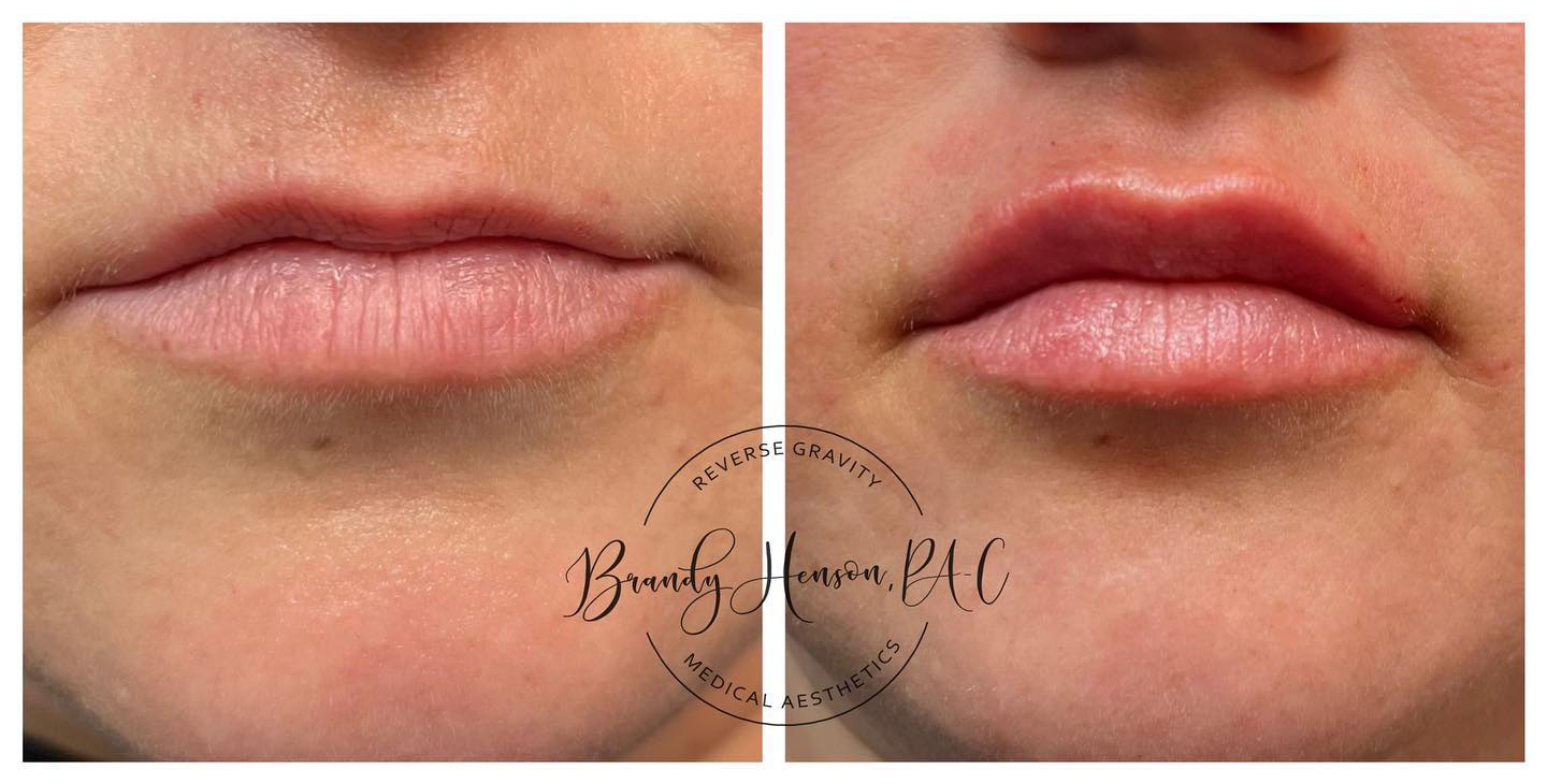 Before and after first time lip filler