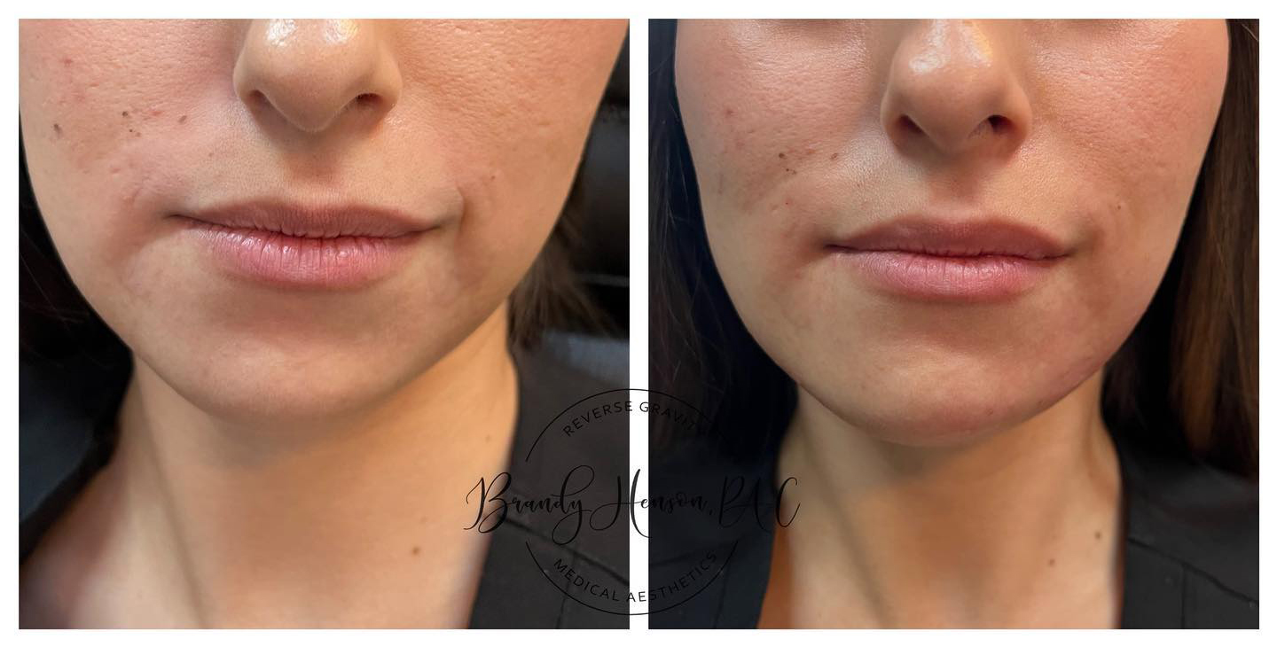 Before and After Jawline Asymmetry Correction with Vollure