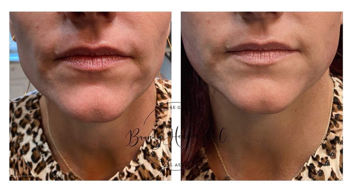 Before and After Jawline Lift with PDO Threads