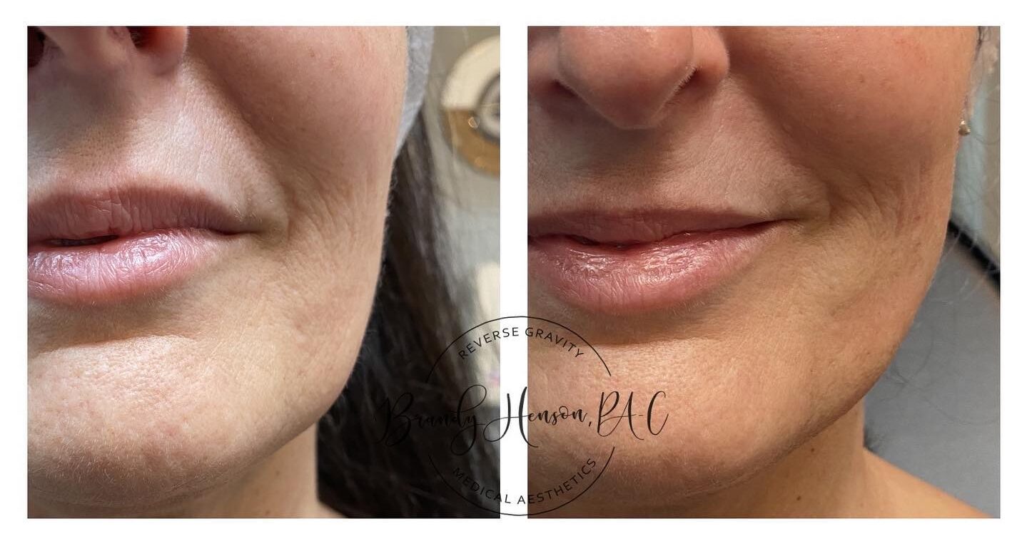 Before and After Jawline Lift with PDO Threads