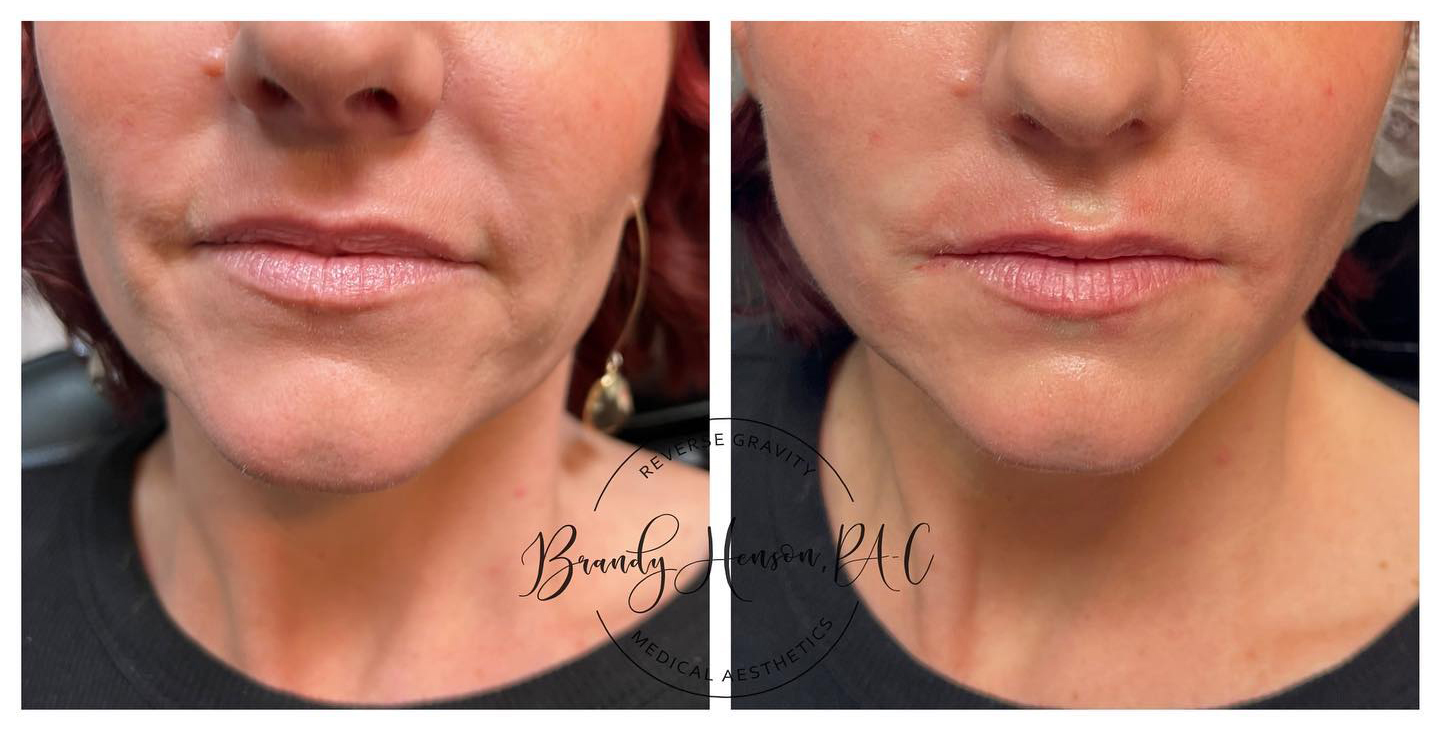 Before and after jowl lift with PDO threads