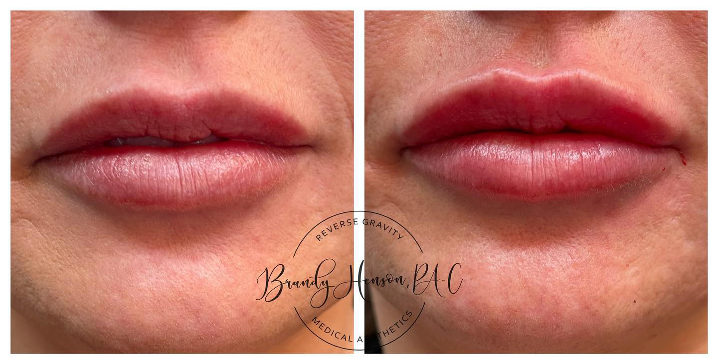 Before and After Lip Filler