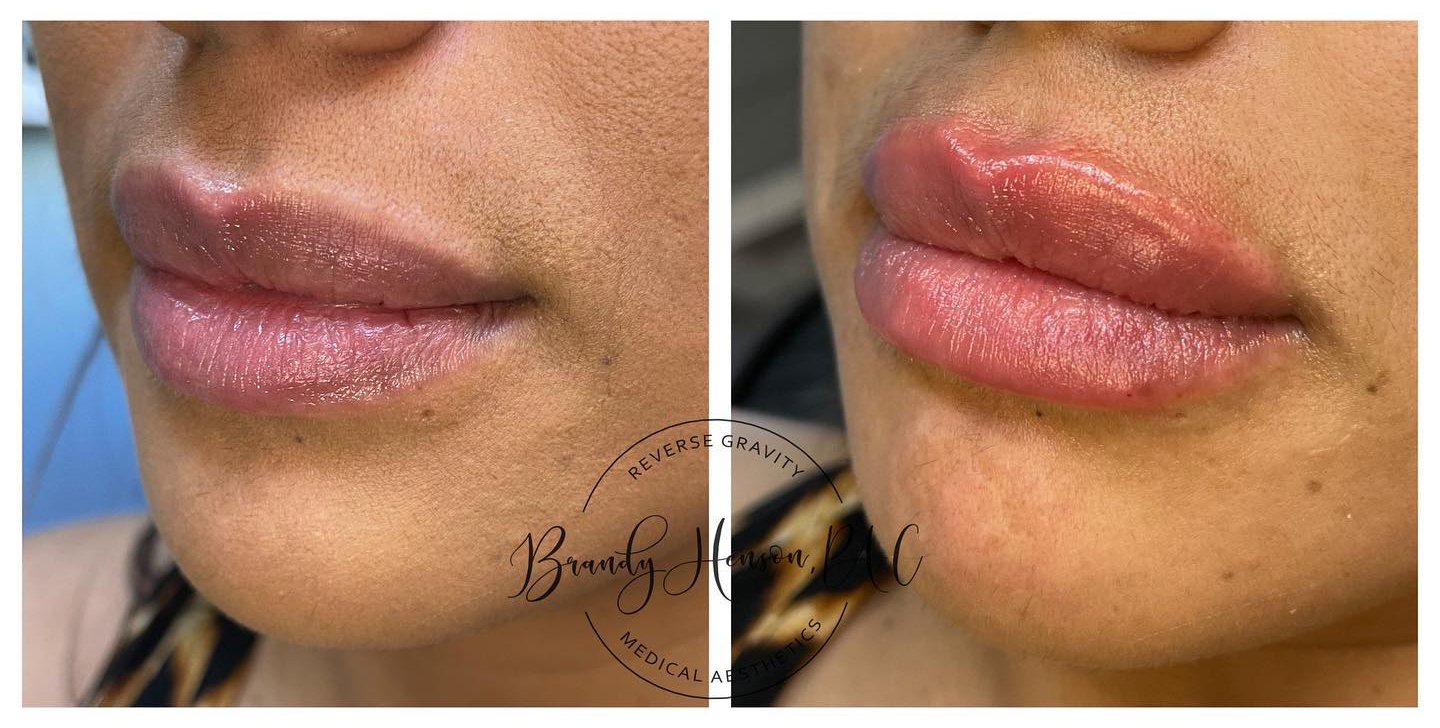 Before and After Lip Filler Volume and Symmetry Correction