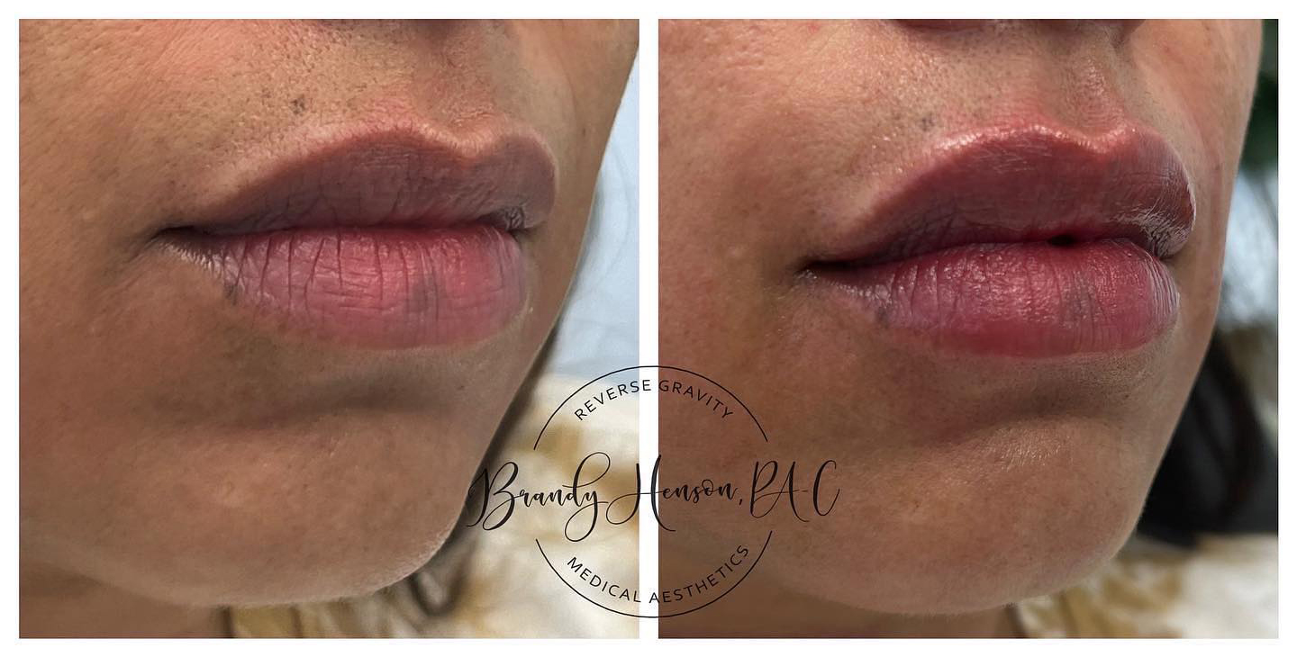 Filler in lip and nasolabial fold before and after