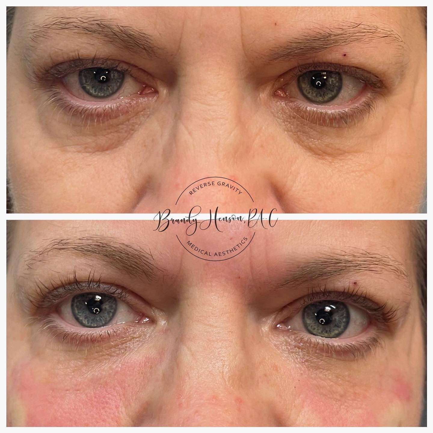 Before and After Tear Trough Correction with PRF