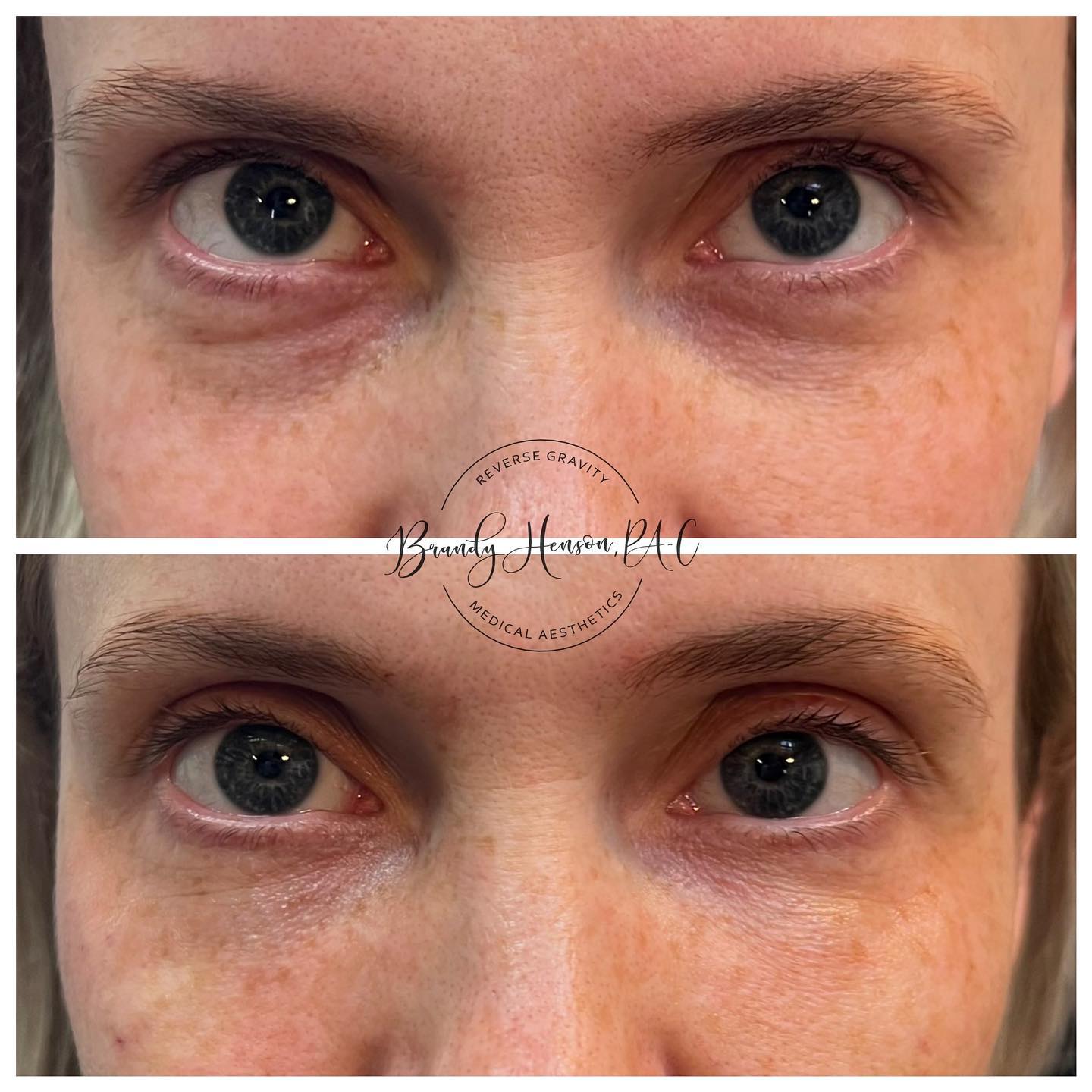 Before and After Undereye Correction