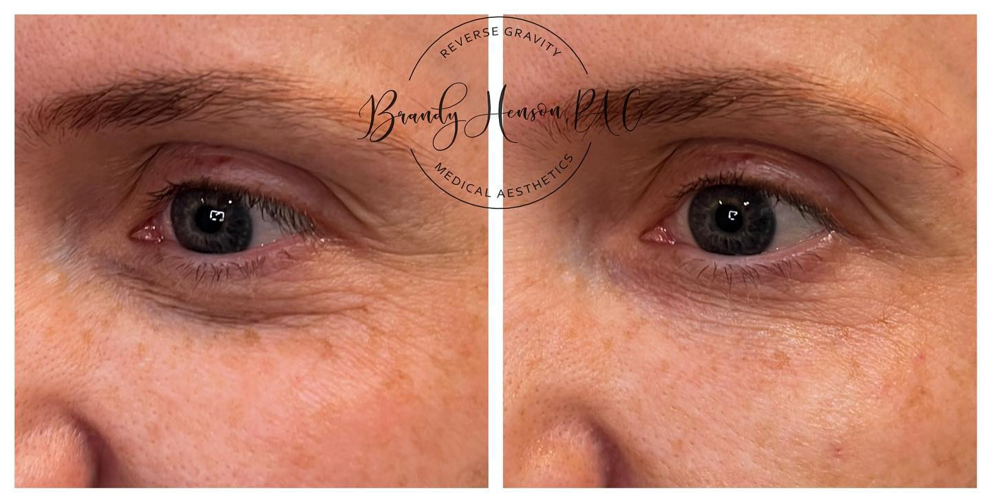 Before and After Undereye Correction
