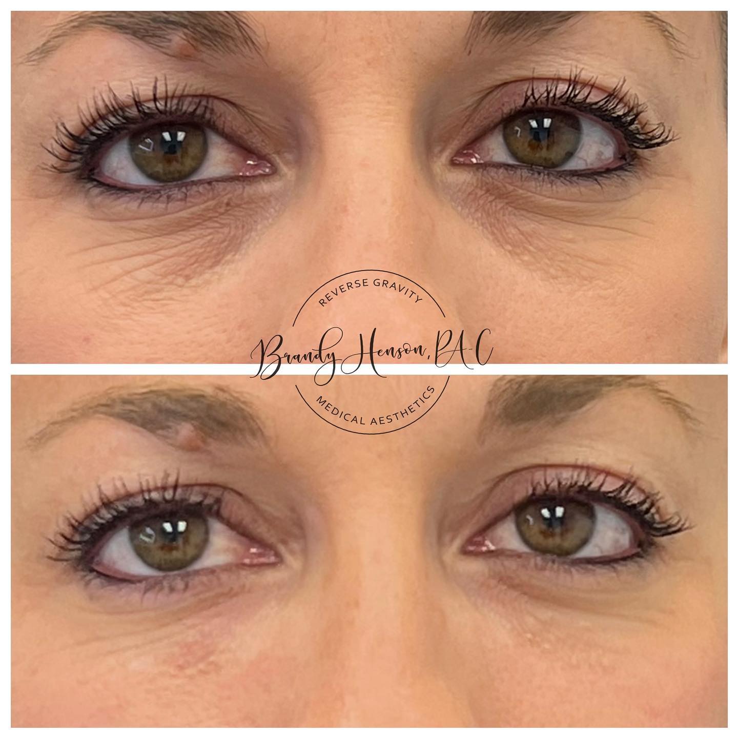 Undereye filler before and after